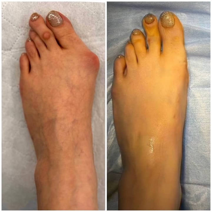 A foot with a bunion before surgery, beside the same foot with the big toe straightened after surgery